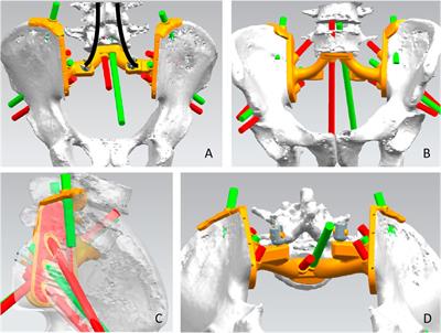 A novel three dimensional-printed biomechanically evaluated patient-specific sacral implant in spinopelvic reconstruction after total en bloc sacrectomy